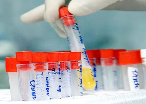 Đừng chủ quan khi nước tiểu có màu lạ ảnh 2